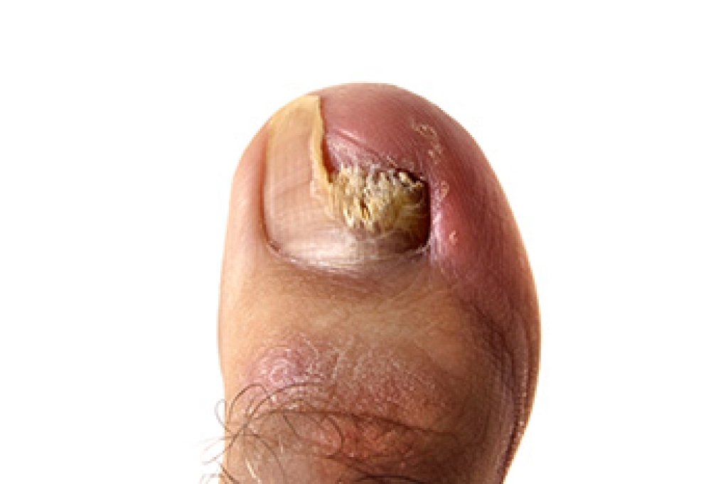 Causes of Thick Toenails