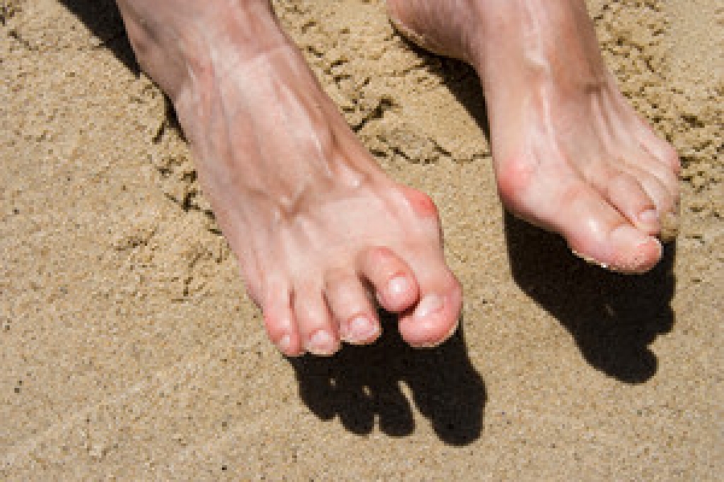 Hammertoe and Toe Joint Imbalance