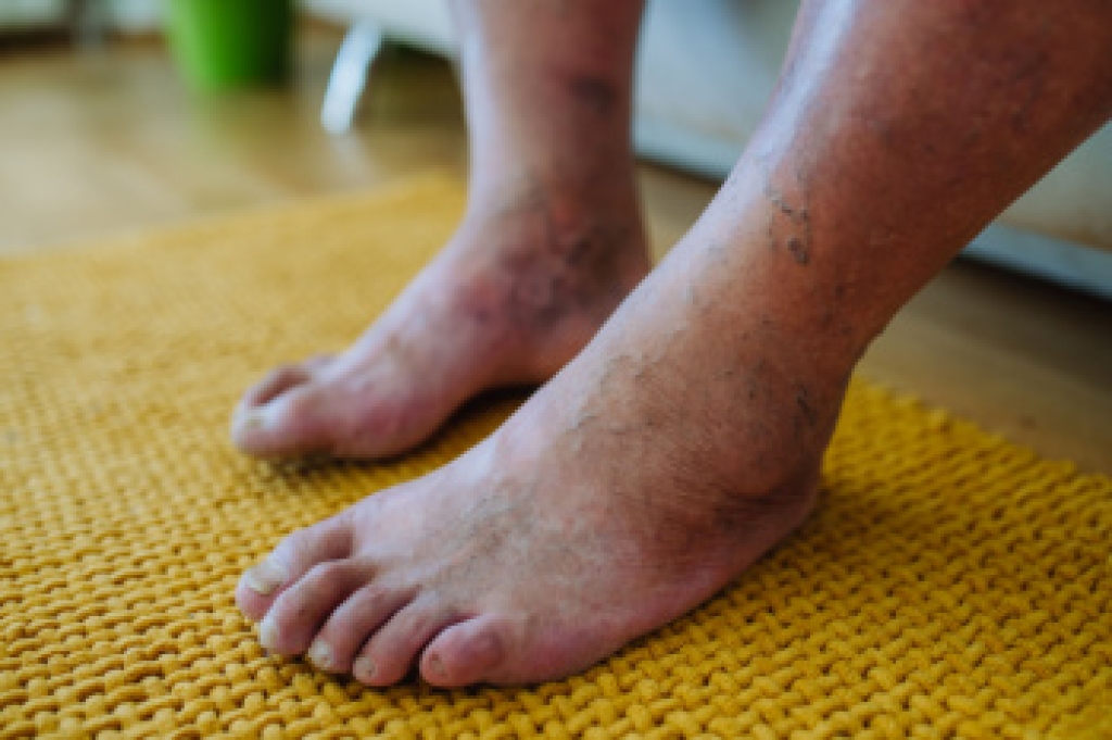 Caring for Swollen Feet Related to Diabetes