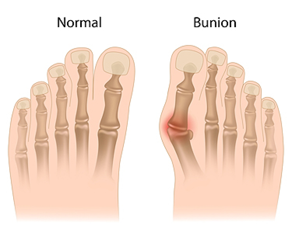 Bunions and Podiatric Care