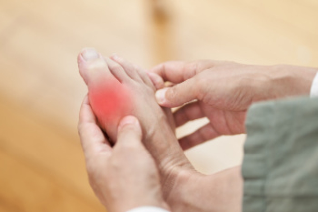 Symptoms of Gout
