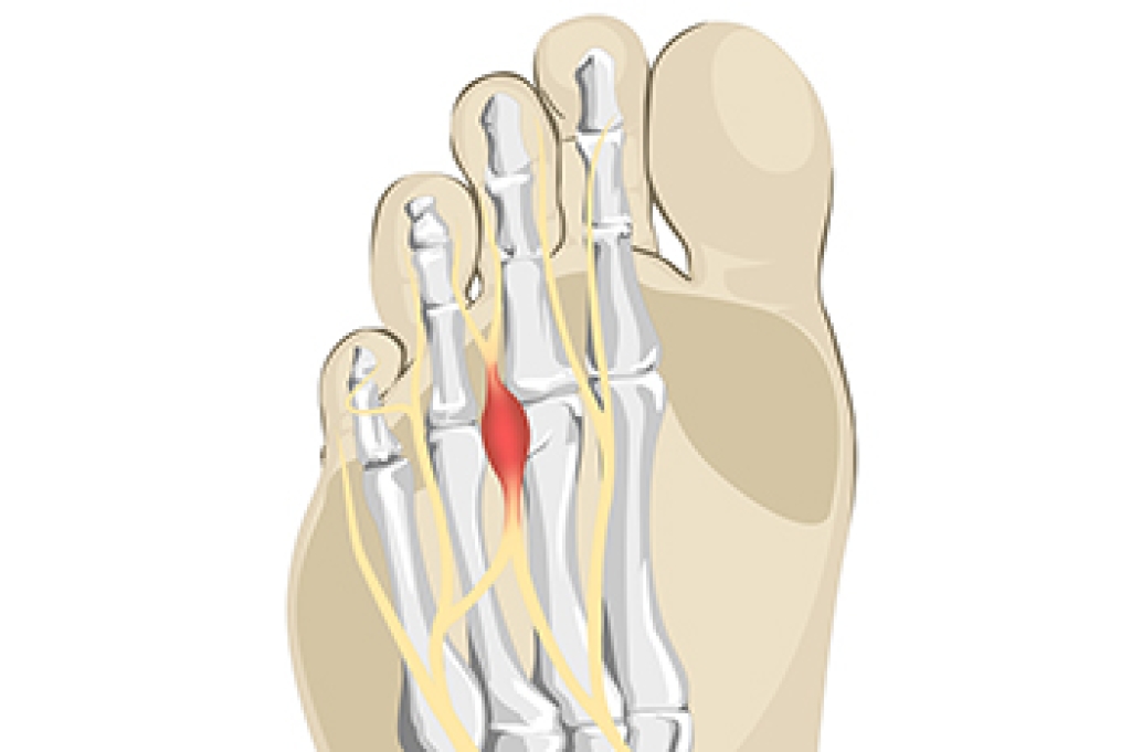 Forefoot Pain May Be Morton’s Neuroma
