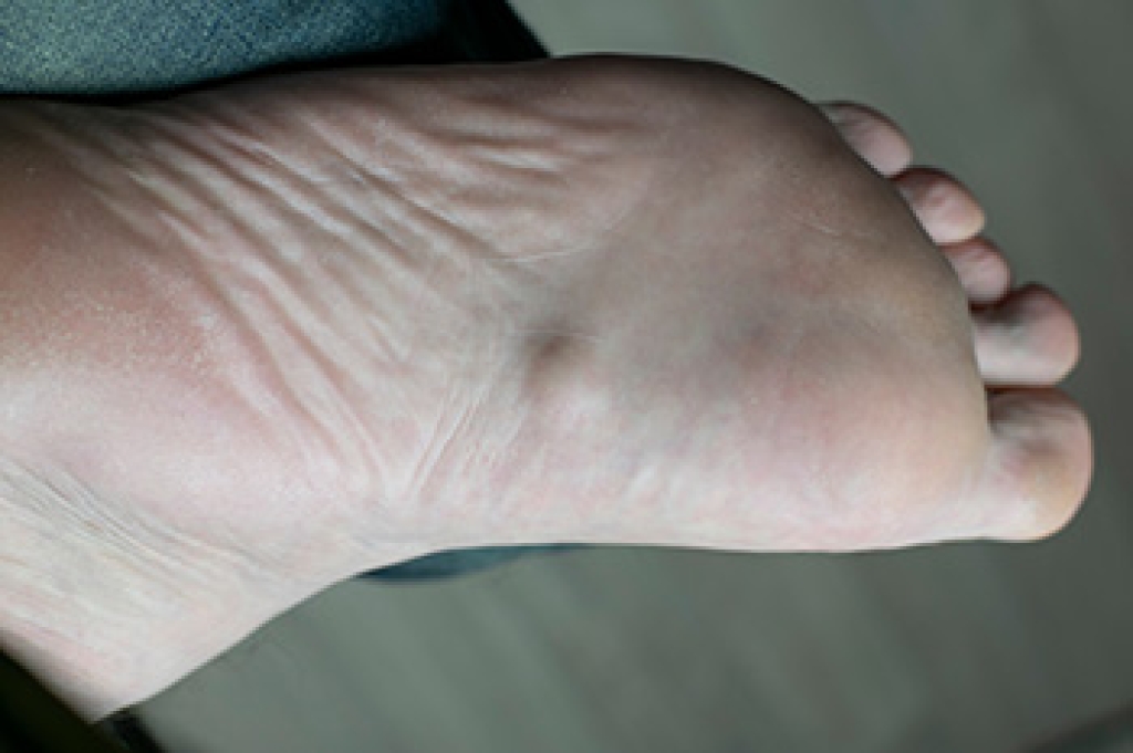 Plantar Fibromatosis and Your Foot Health