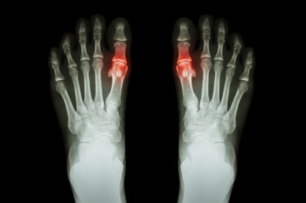 Gout Is an Inflammatory Arthritis That Affects the Feet