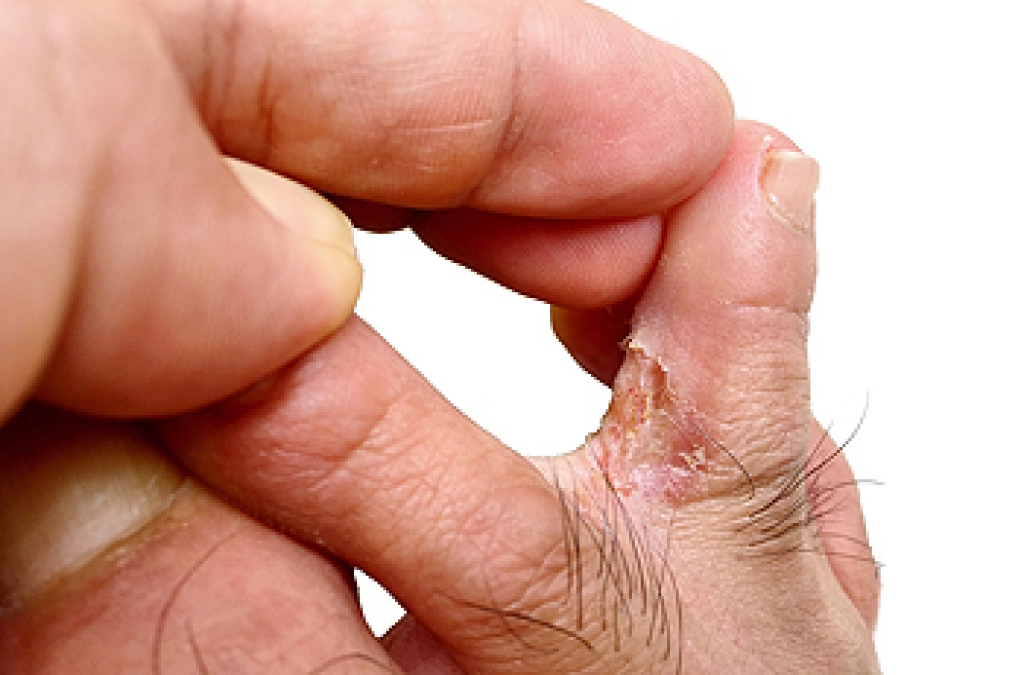 Telltale Clues of an Athlete’s Foot Infection