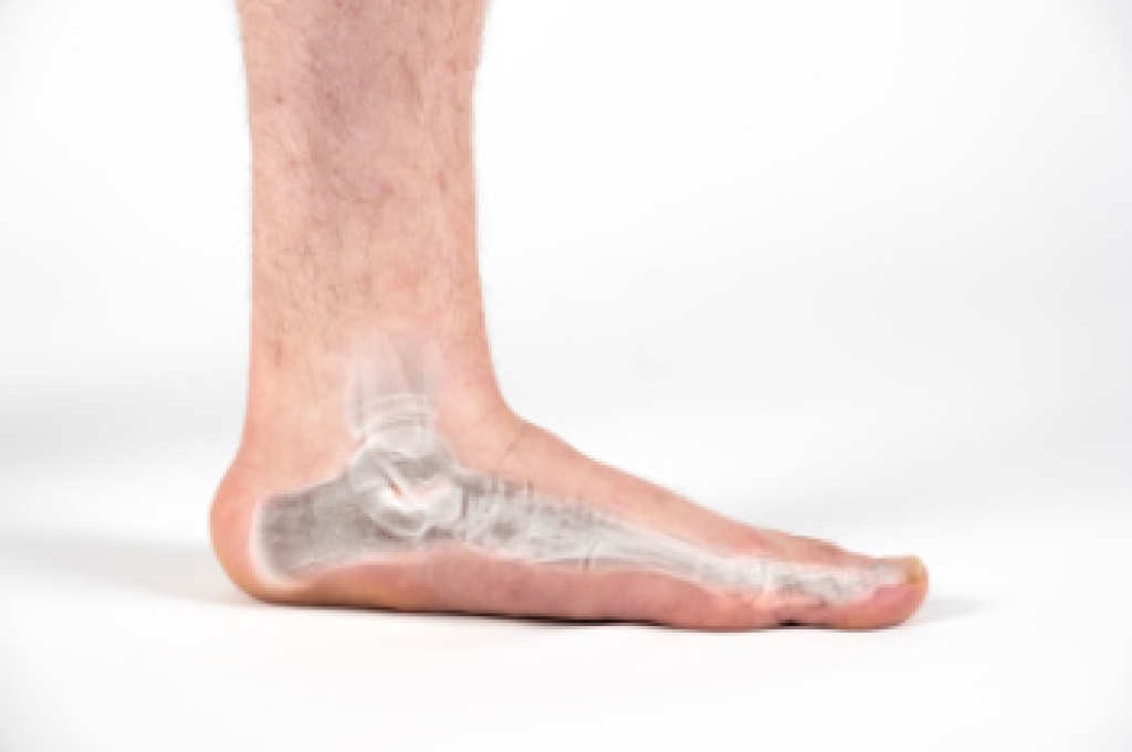 When Flat Feet Begin to Cause Discomfort