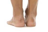 Heel Lumps and What Causes Them