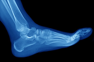 Athletes and Stress Fractures
